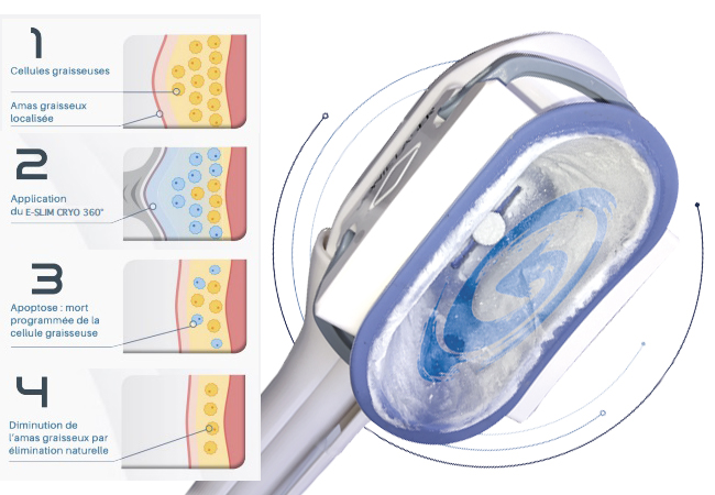 Les résultat minceur par Cryolipolyse