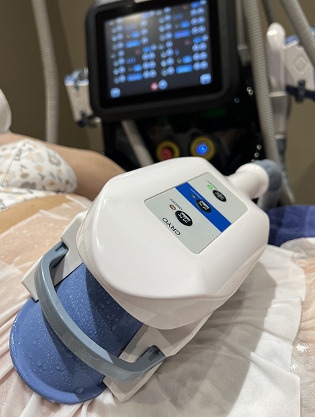 La méthode minceur par Cryolipolyse
