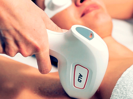 Epilation définitive au laser